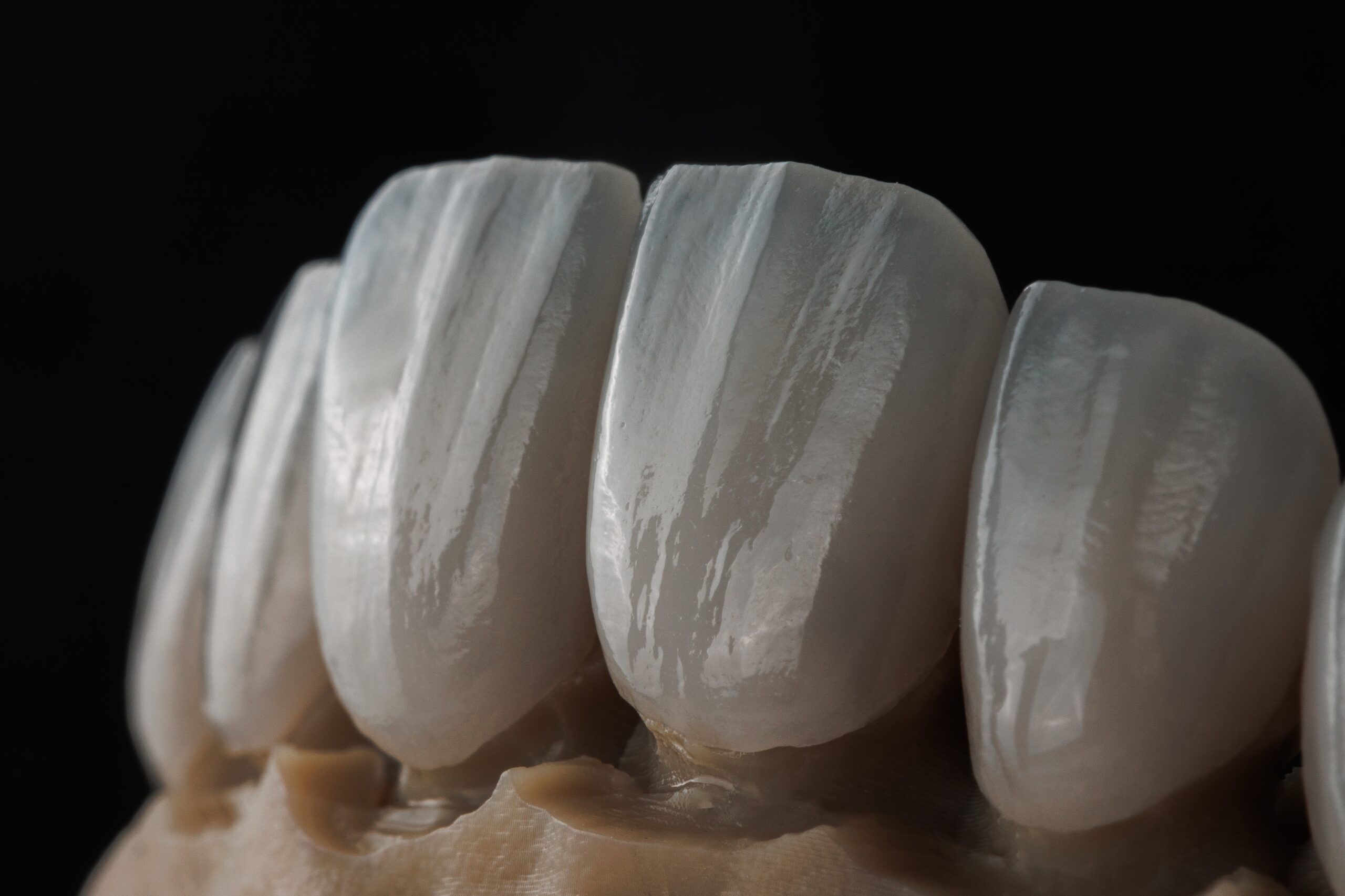 Will porcelain veneers last