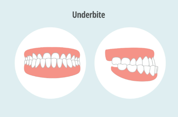 Exploring underbite treatment options