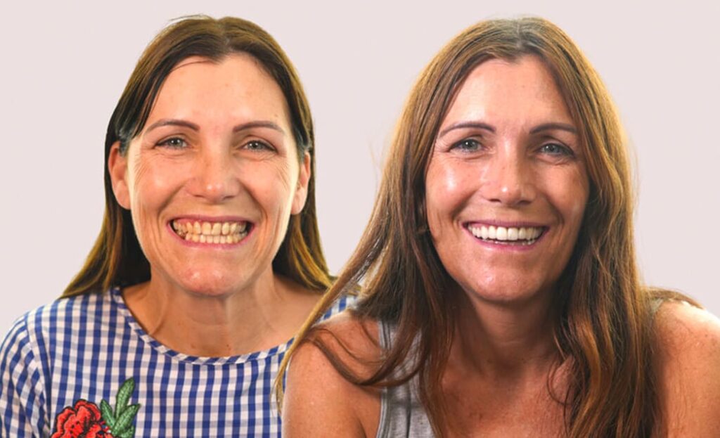 Veneer Consultation With Dentist