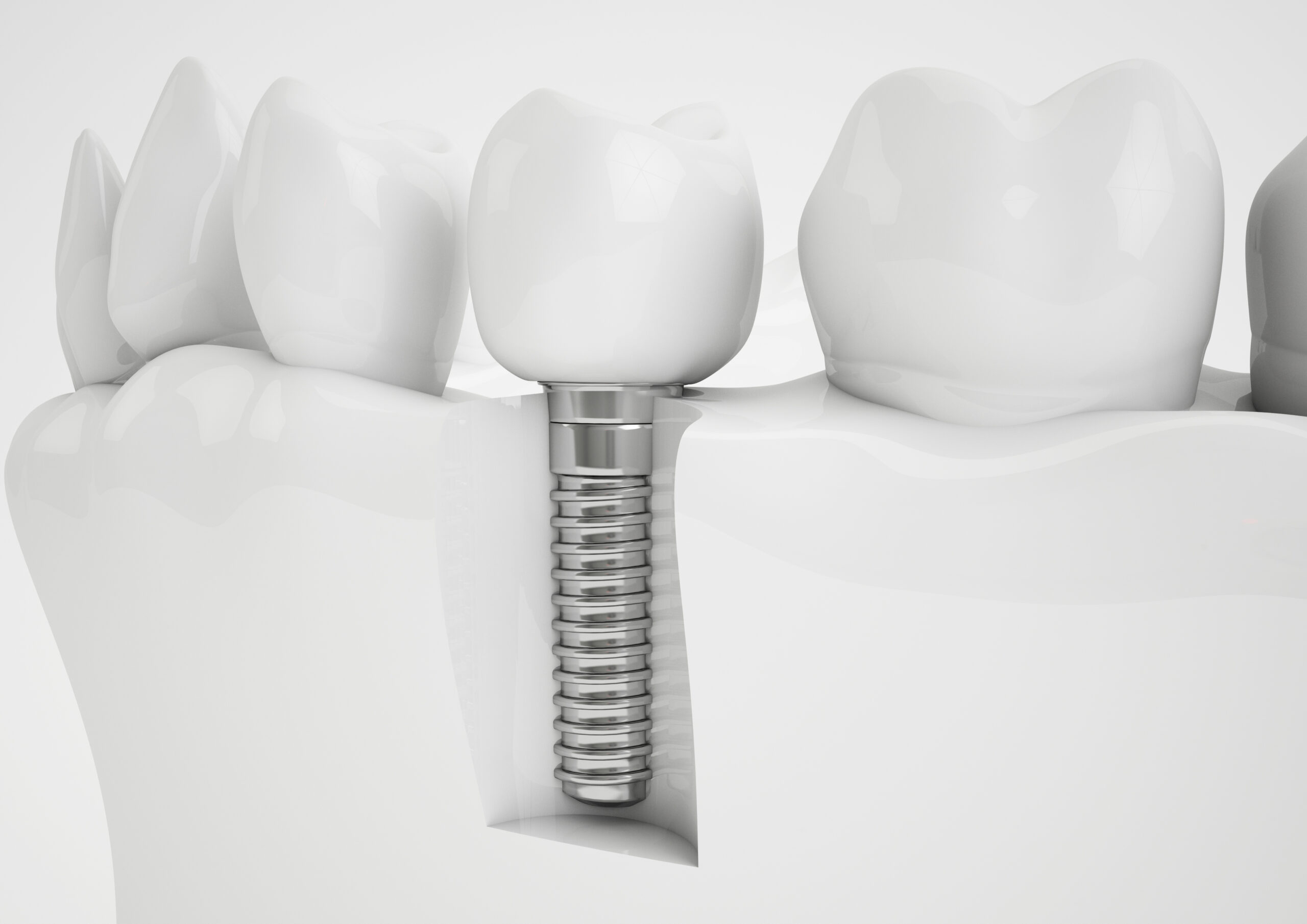What are dental implants 