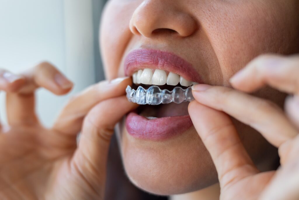 Invisalign The clear aligner alternative