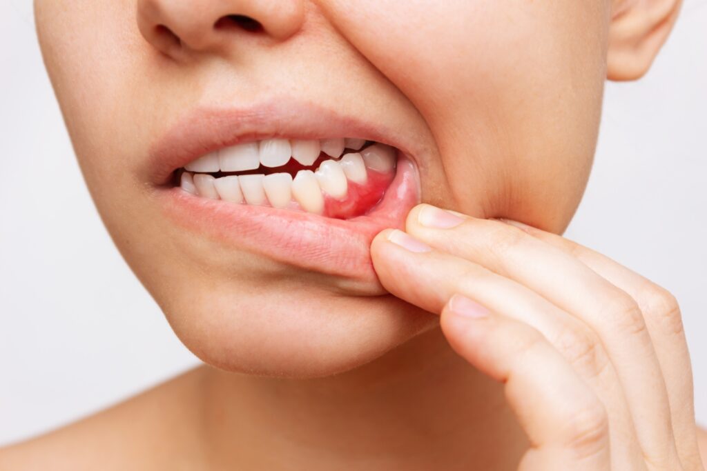 Receding gums and inflammation