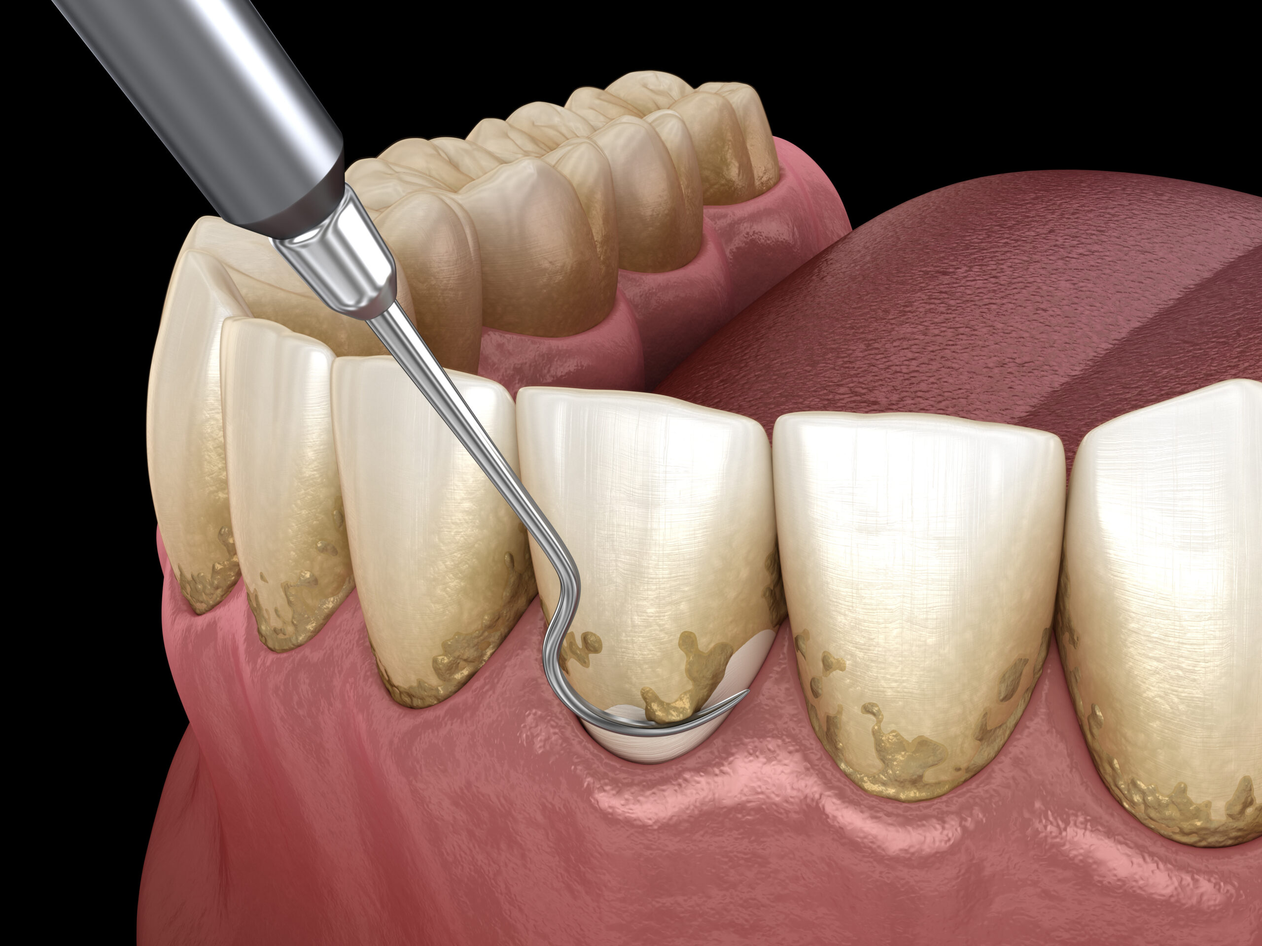 Periodontal Disease 