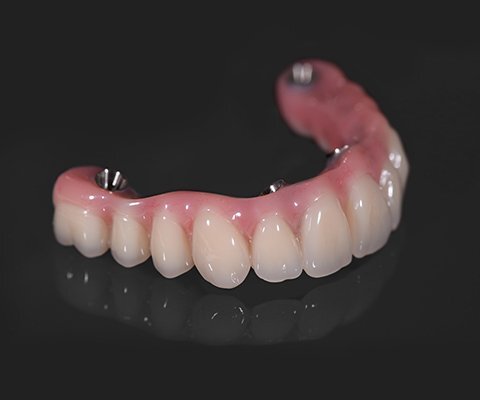 All-on-4 dental implants: A full smile solution 