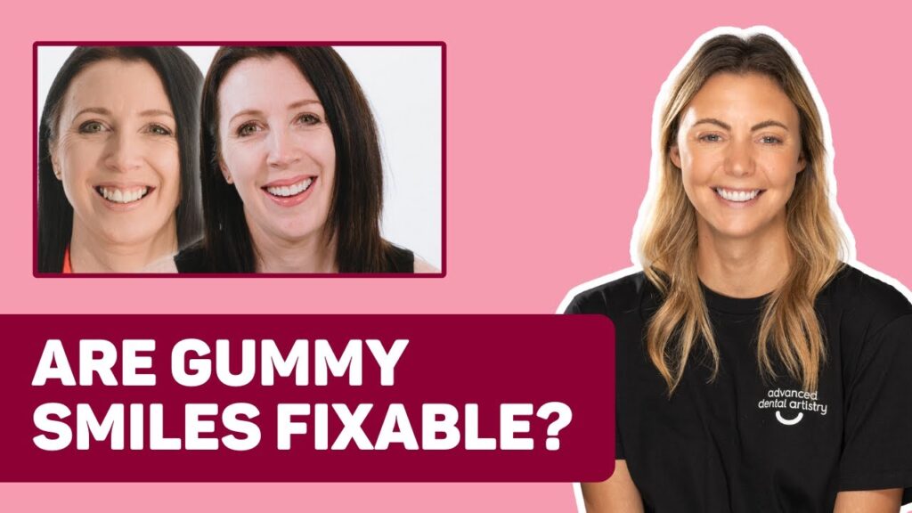 Gummy Smile Treatments