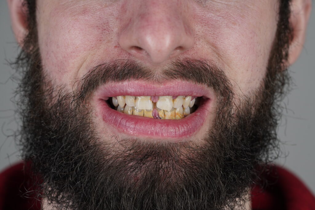 long-term effects of missing teeth