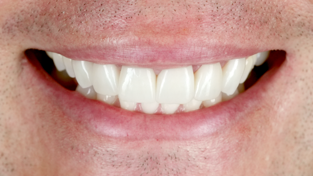 Why choose porcelain veneers