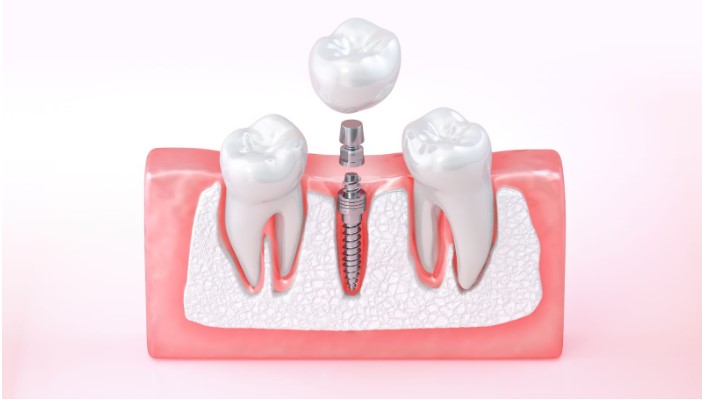 whar are dental implants