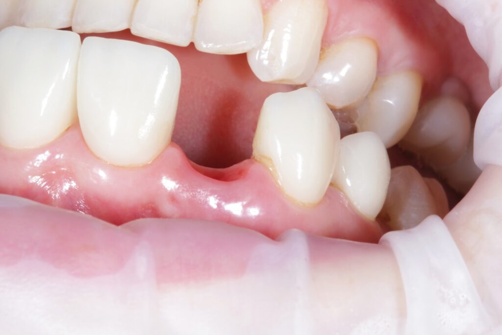 Shifting and misalignment of teeth