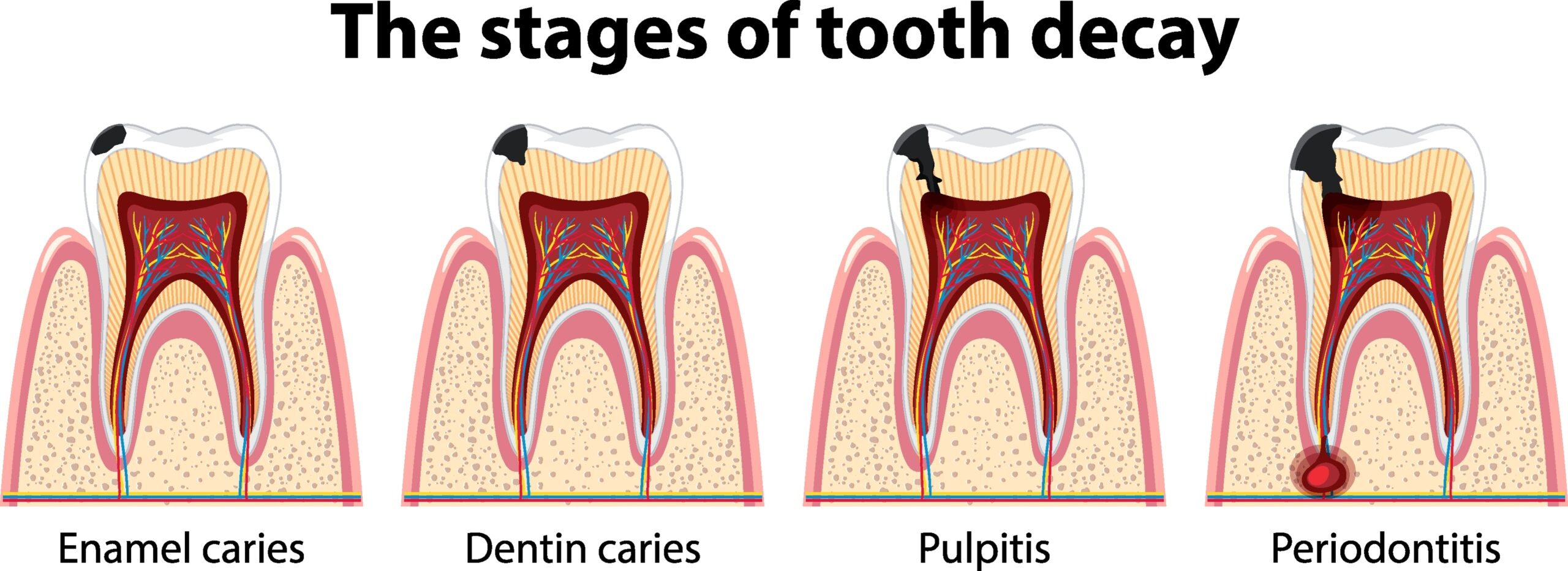 Stages of Tooth Decay