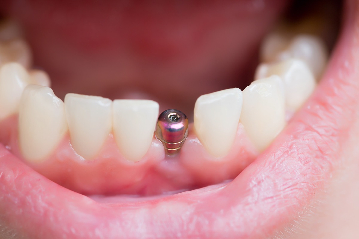 What are dental implants