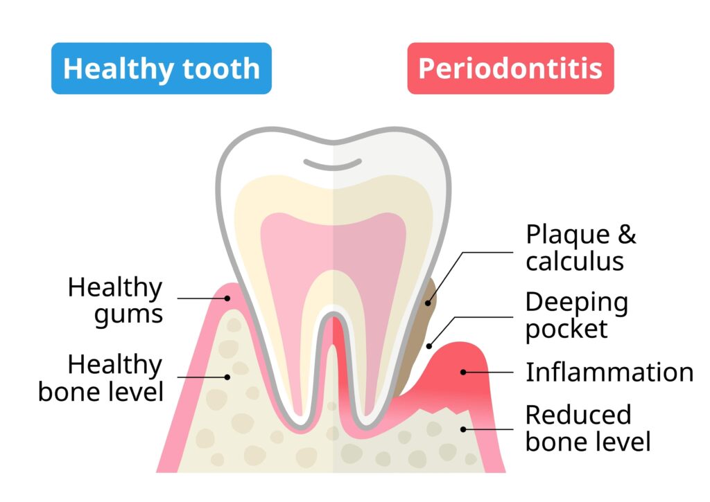 Periodontal Disease