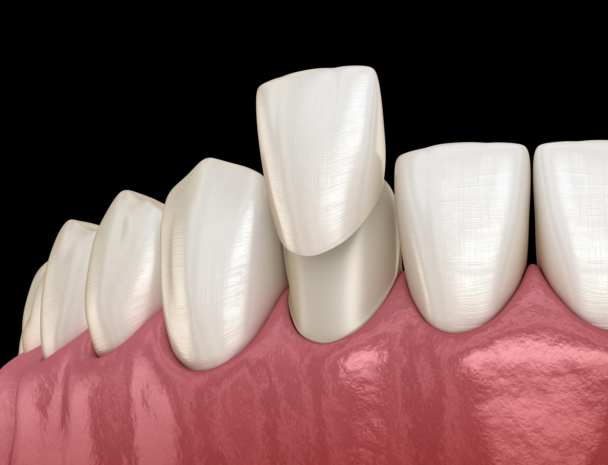 Porcelain Veneers