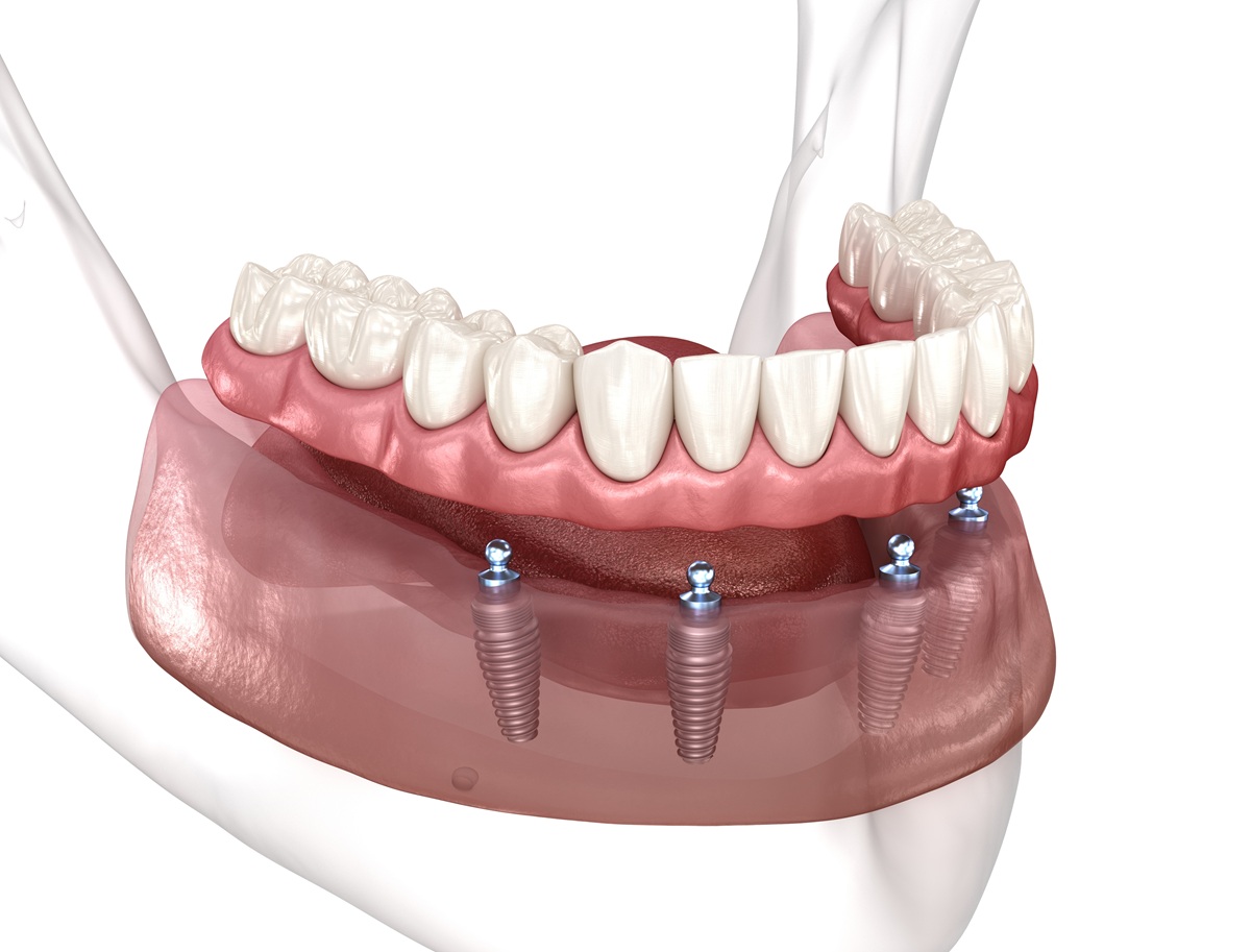 All-on-4 for severely worn teeth