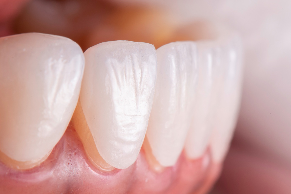 Benefits of porcelain veneers