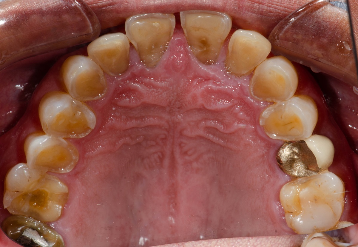 The,Worn,Down,Nearly,Exposed,Pulp,Teeth,And,A,Gold