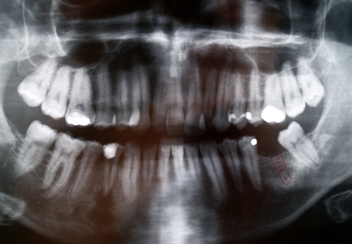 eligibility for tooth replacement