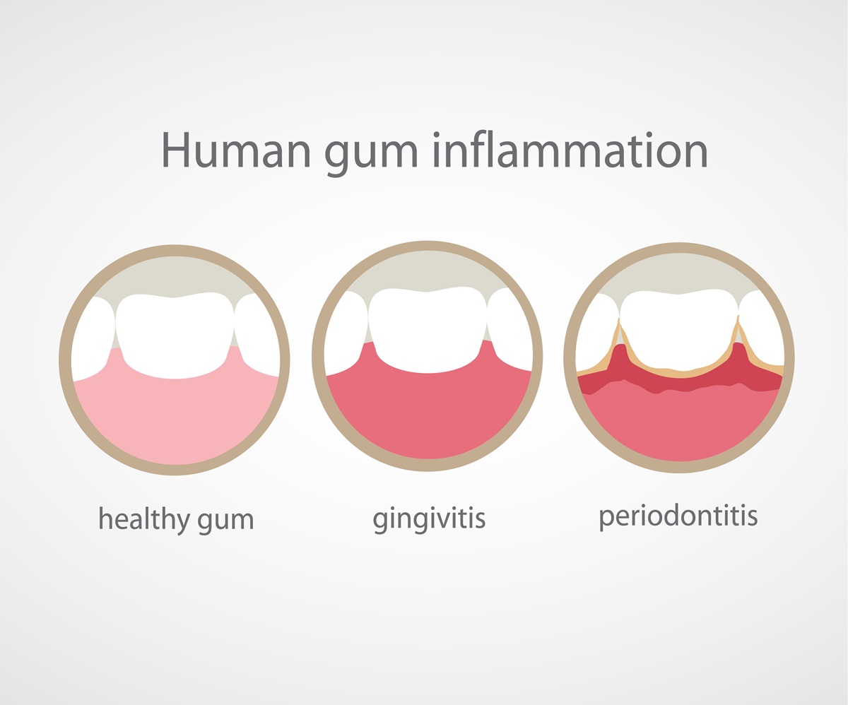 human gum inflammation