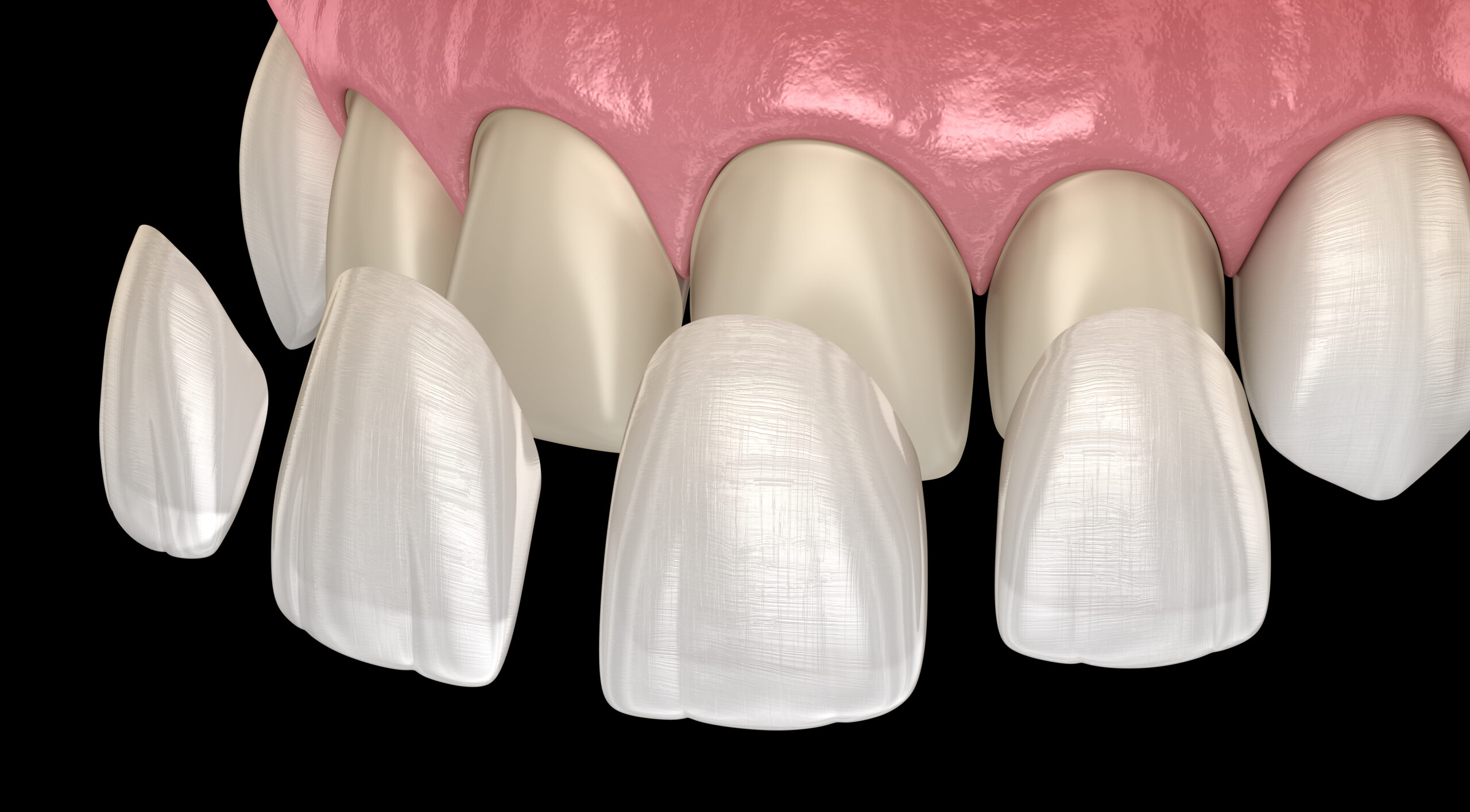 What are porcelain veneers